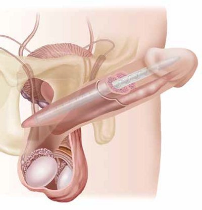 grafica che mostra l'impianto di protesi peniena malleabile