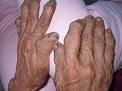 artrite reumatoide