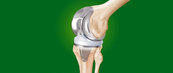 disegno di articolazione ginocchio con protesi