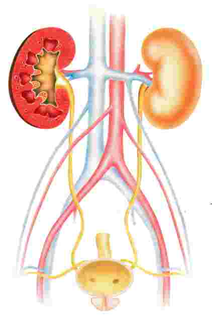 Cateterismo - tipi di cateteri vescicali