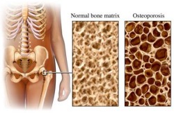 disegno ossa osteoporosi 
