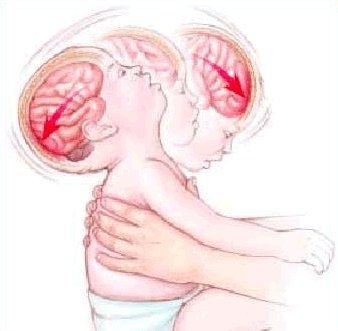 Shaken Baby Syndrome: disegno di neonato percosso da scuotimento