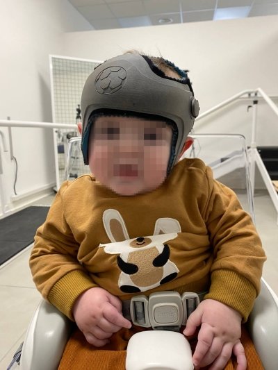 bambino indossa un caschetto per correggere la plagiocefalia 