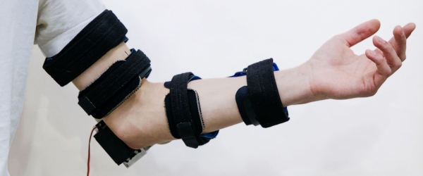 foto di mano bionica su un braccio 